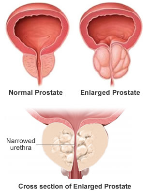 Prostatitis és a betegség utak